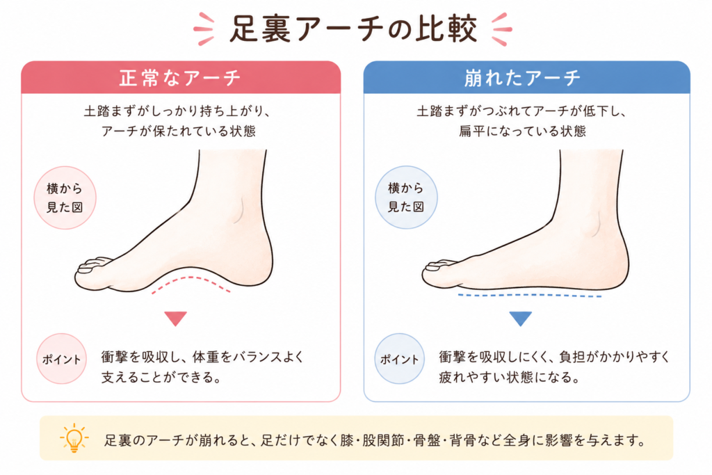 正常な足裏アーチと崩れた足裏アーチの比較図